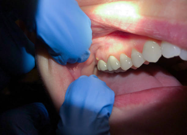 Best Dentist for Tooth Abscess  in Charlevoix, MI